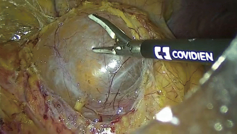 Операції з видалення пухлин перестають бути унікальними для фахівців Ковельського МТМО